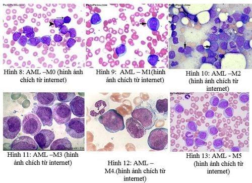 Bạch cầu cấp tính dòng tế bào tủy xương (AML): Phân loại